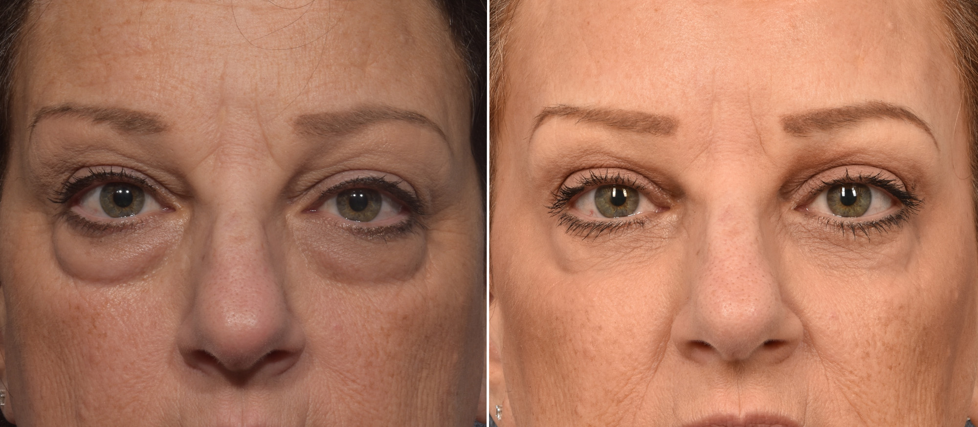 Lower Blepharoplasty Before & After Gallery - Patient 161638 - Image 1