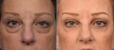 Lower Blepharoplasty Before & After Gallery - Patient 161638 - Image 1