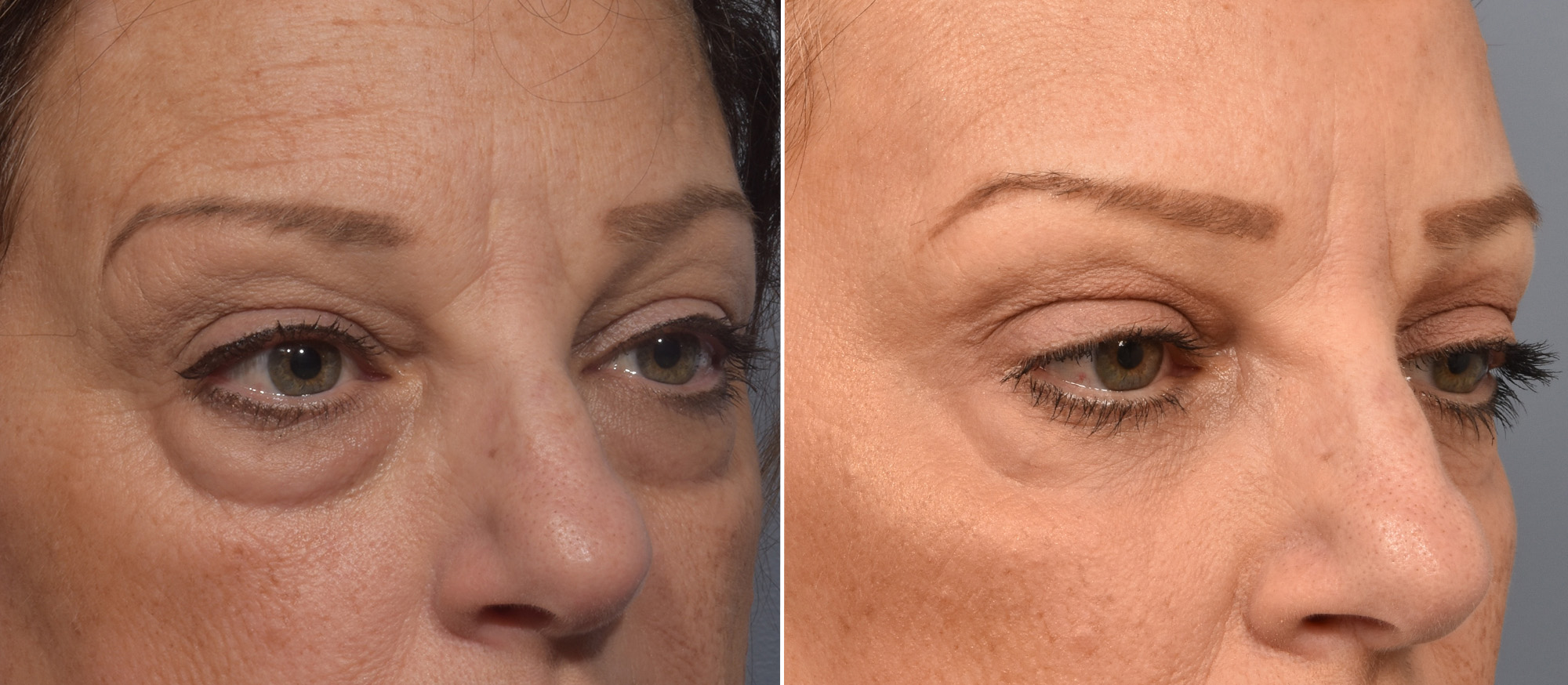 Lower Blepharoplasty Before & After Gallery - Patient 161638 - Image 2
