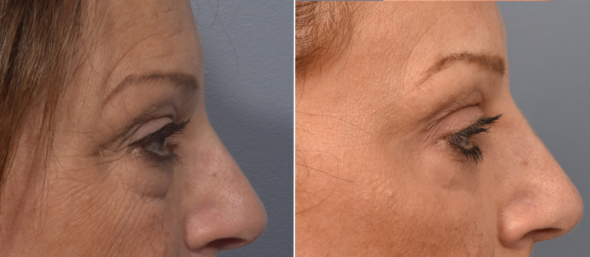 Lower Blepharoplasty Before & After Gallery - Patient 161638 - Image 3
