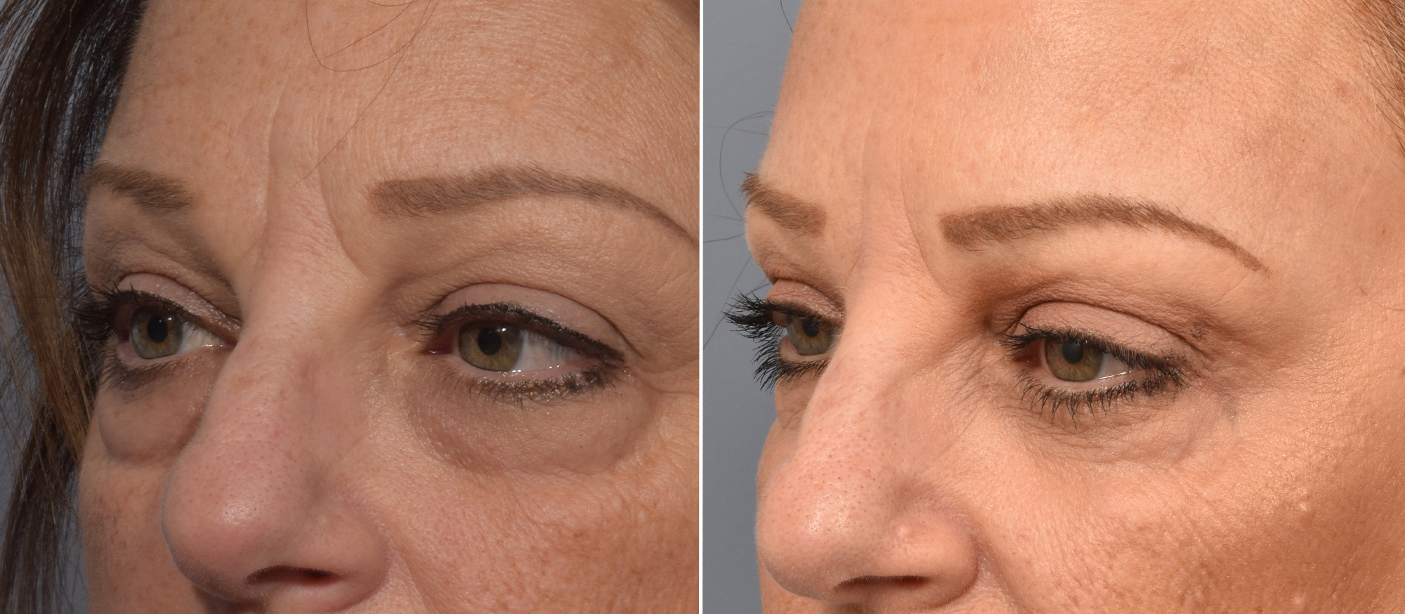 Lower Blepharoplasty Before & After Gallery - Patient 161638 - Image 4