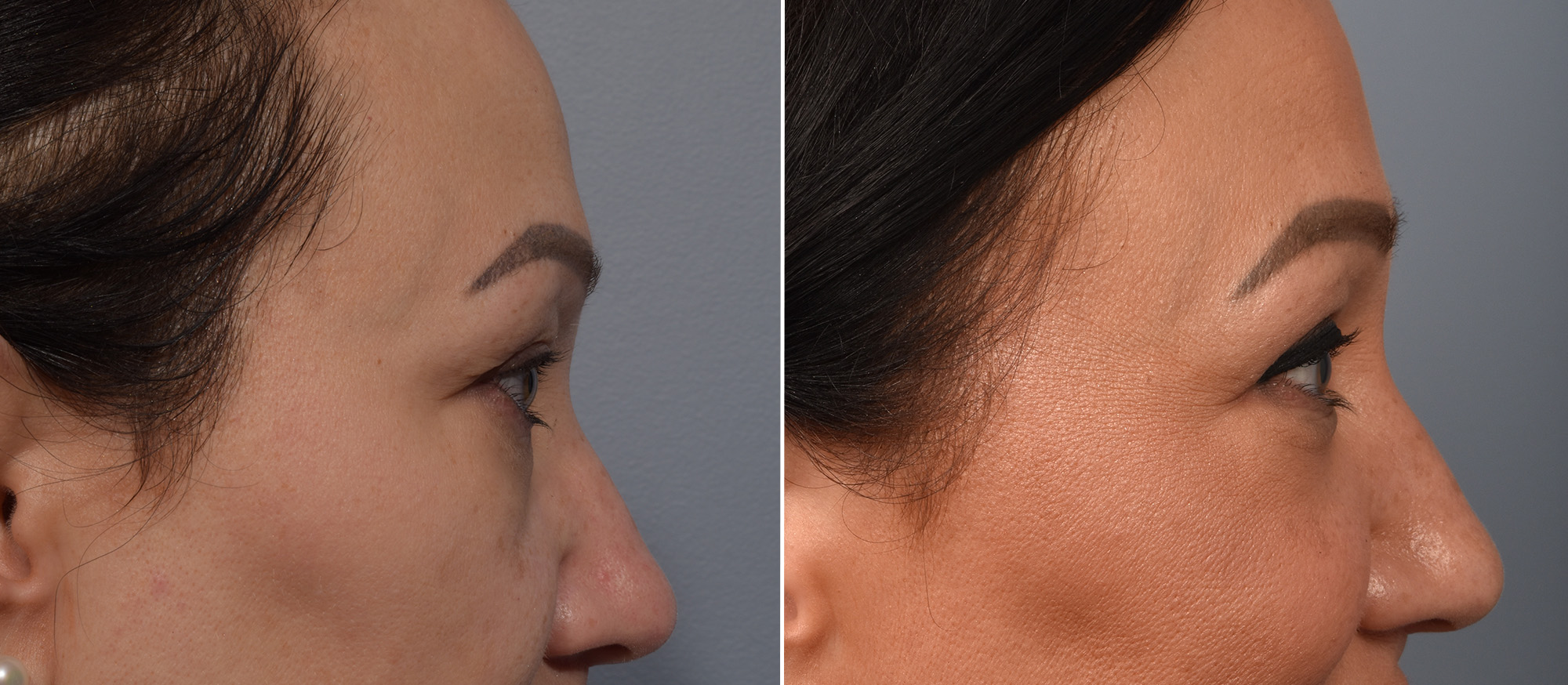 Upper Blepharoplasty Before & After Gallery - Patient 777743 - Image 3