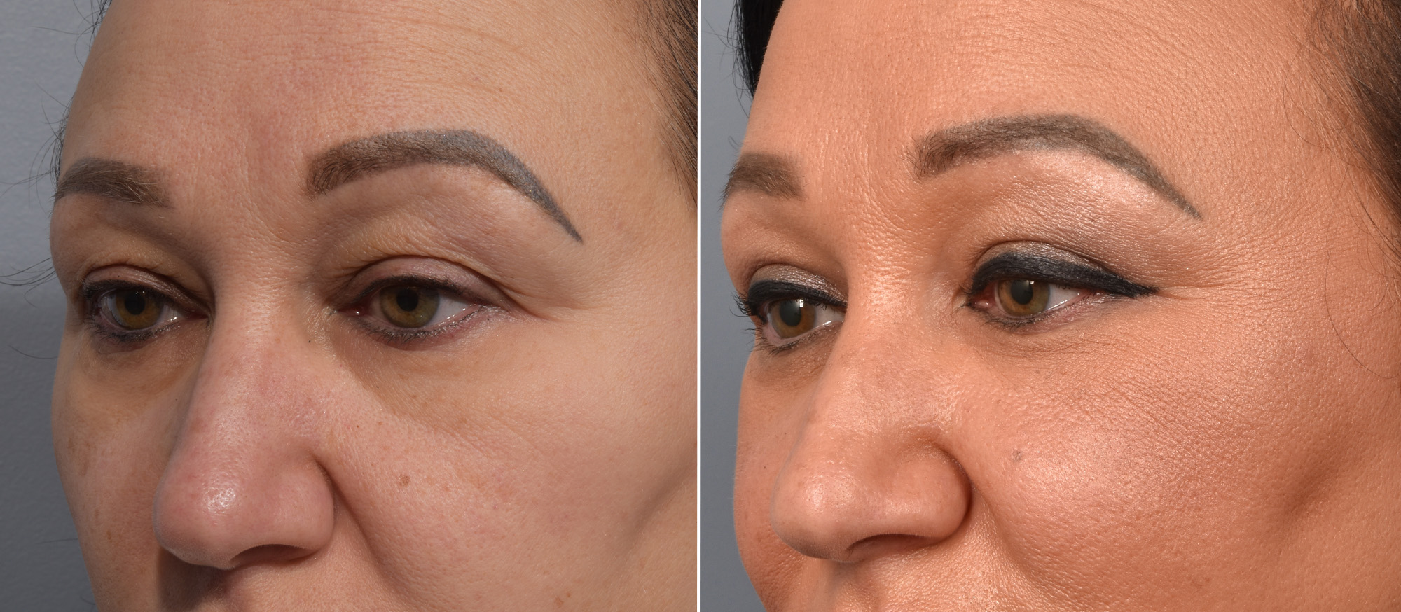 Upper Blepharoplasty Before & After Gallery - Patient 777743 - Image 4