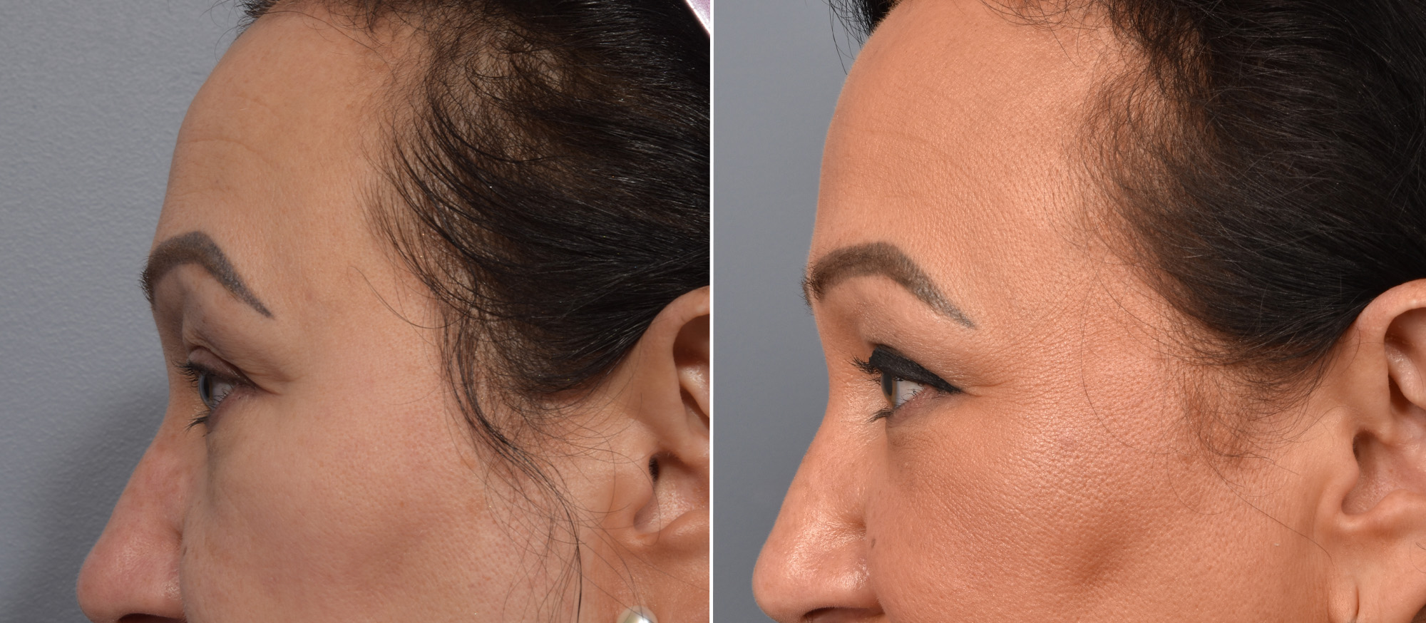Upper Blepharoplasty Before & After Gallery - Patient 777743 - Image 5