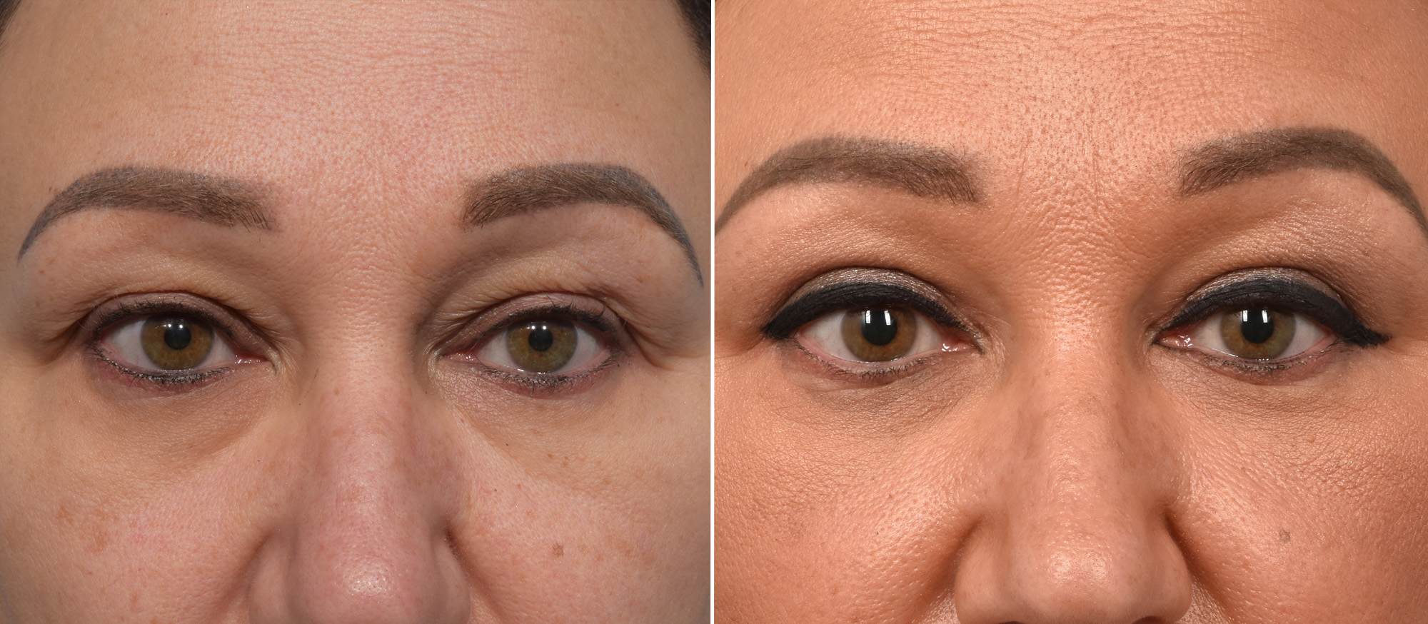 Upper Blepharoplasty Before & After Gallery - Patient 777743 - Image 1