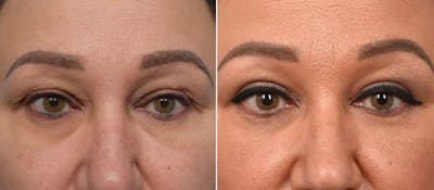 Upper Blepharoplasty Before & After Gallery - Patient 777743 - Image 1