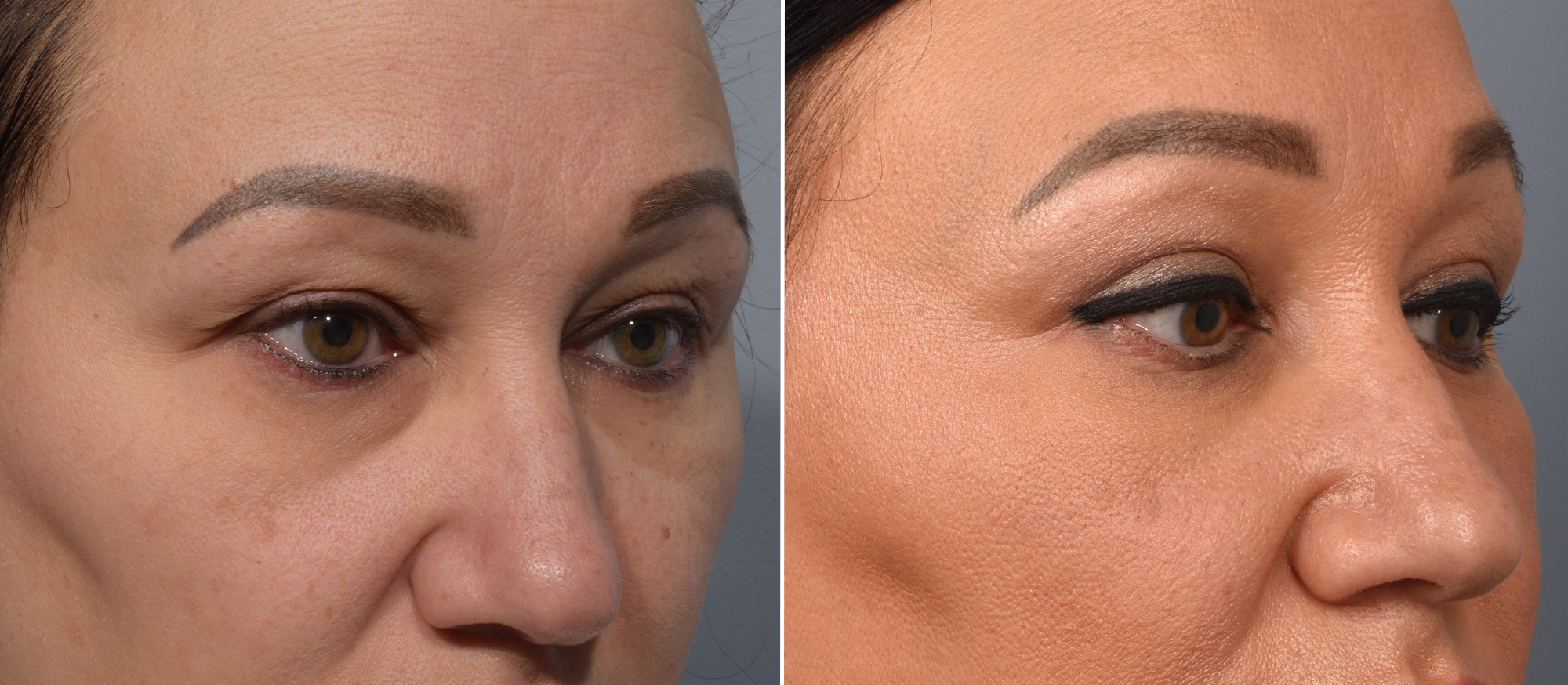Upper Blepharoplasty Before & After Gallery - Patient 777743 - Image 2