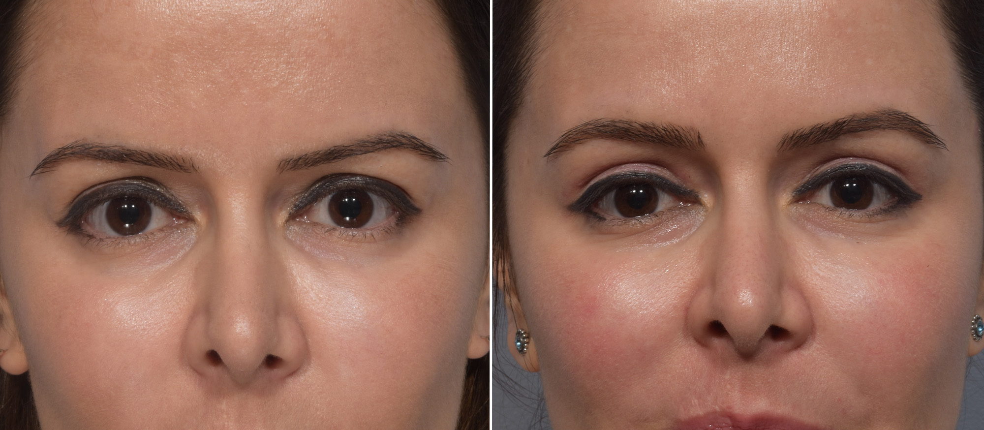 Upper Blepharoplasty Before & After Gallery - Patient 411356 - Image 1