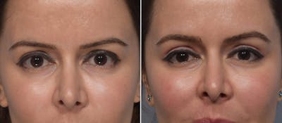 Upper Blepharoplasty Before & After Gallery - Patient 411356 - Image 1