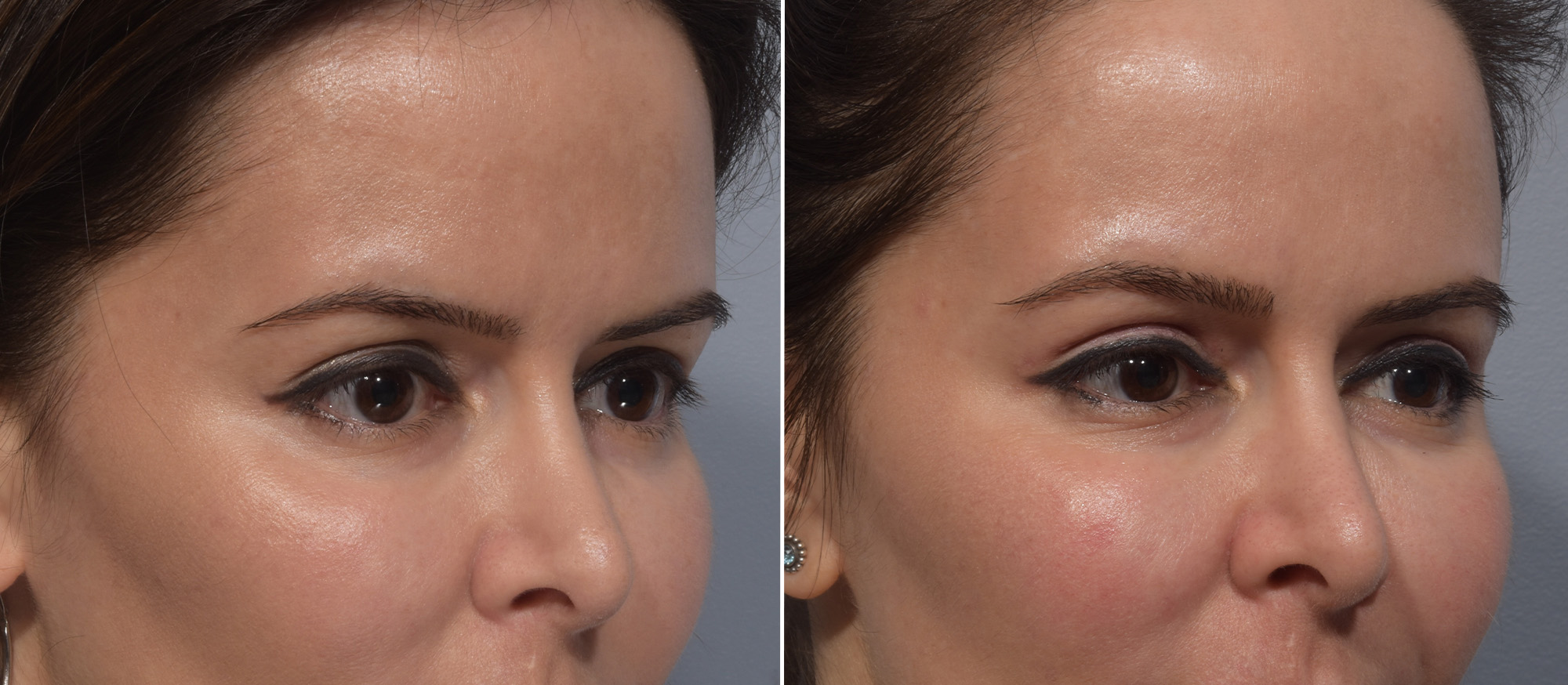 Upper Blepharoplasty Before & After Gallery - Patient 411356 - Image 2