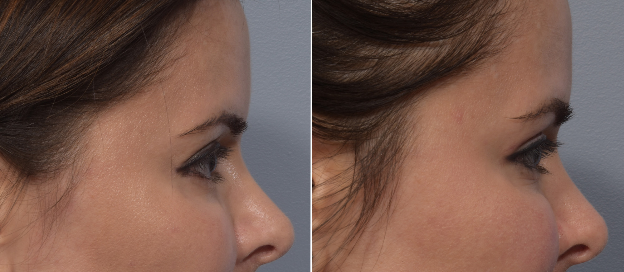 Upper Blepharoplasty Before & After Gallery - Patient 411356 - Image 3