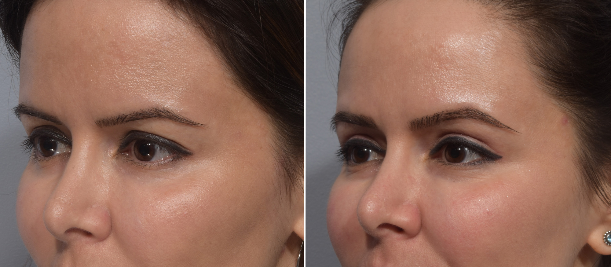 Upper Blepharoplasty Before & After Gallery - Patient 411356 - Image 4