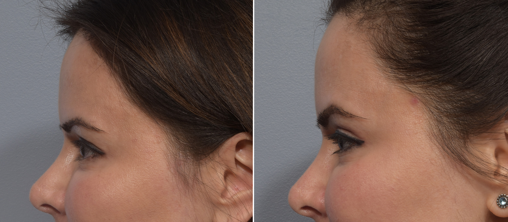 Upper Blepharoplasty Before & After Gallery - Patient 411356 - Image 5
