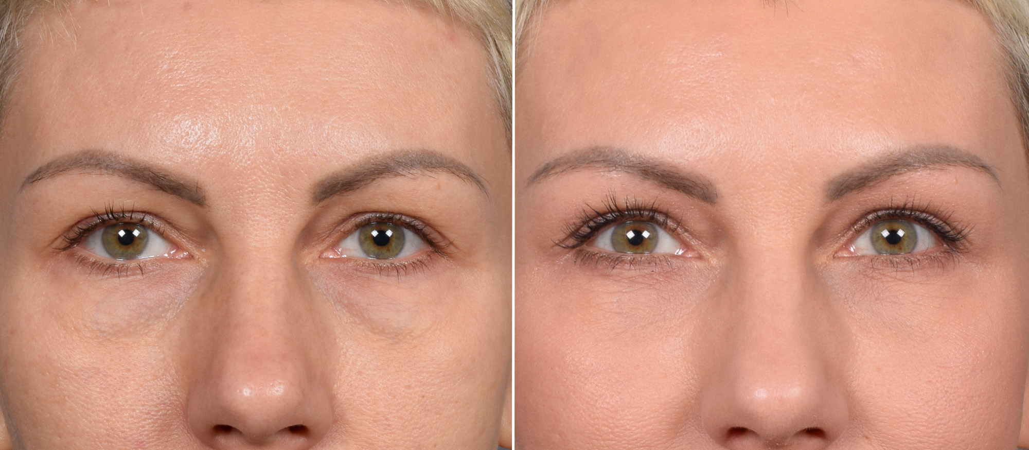 CO2 Laser Before & After Gallery - Patient 637576 - Image 8