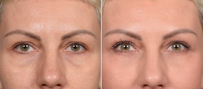 Lower Blepharoplasty Before & After Gallery - Patient 117215 - Image 1