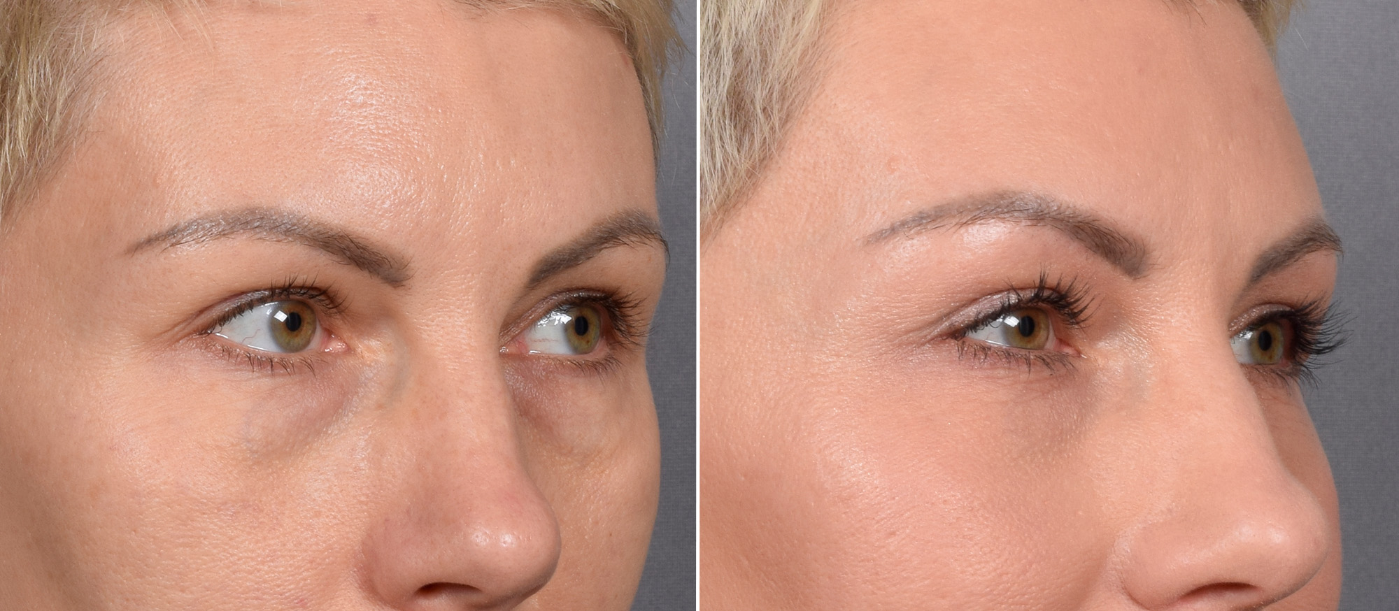 CO2 Laser Before & After Gallery - Patient 637576 - Image 6