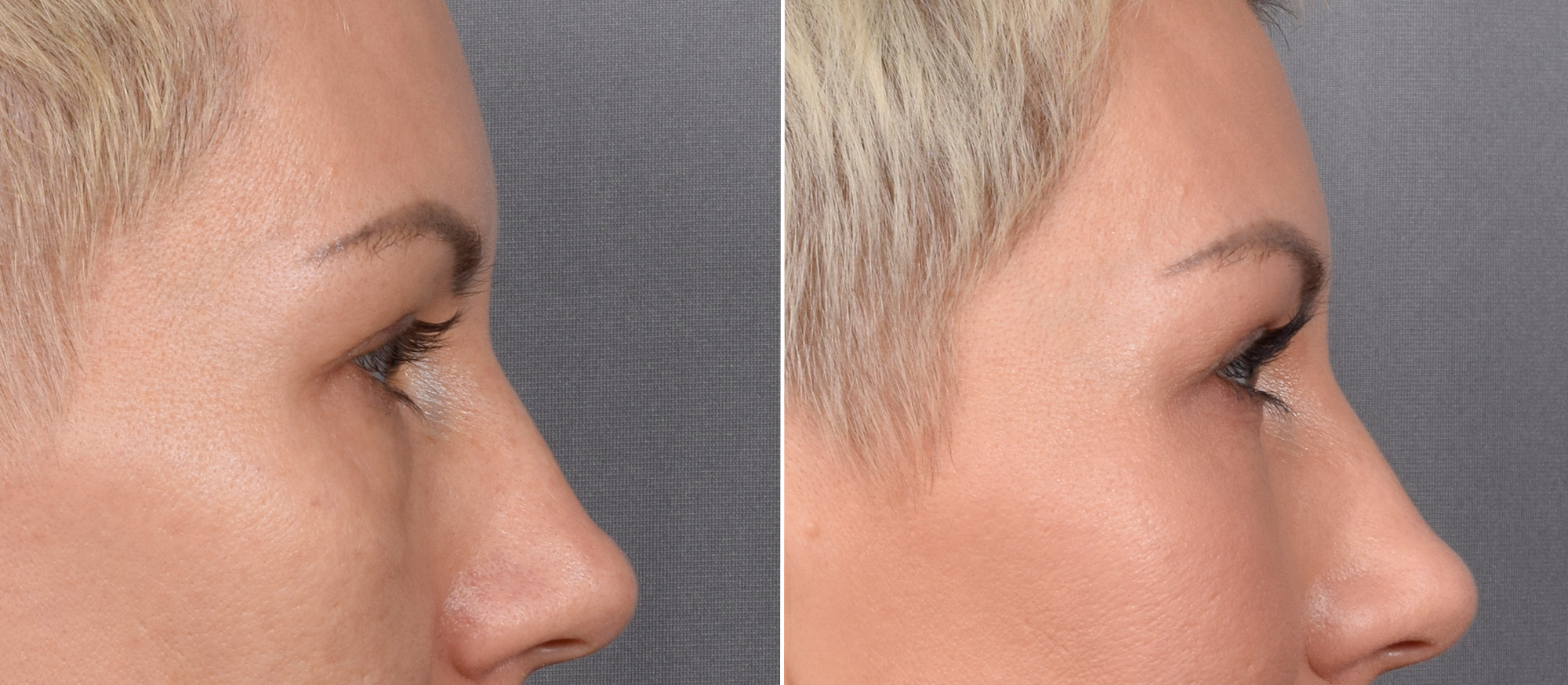 CO2 Laser Before & After Gallery - Patient 637576 - Image 7