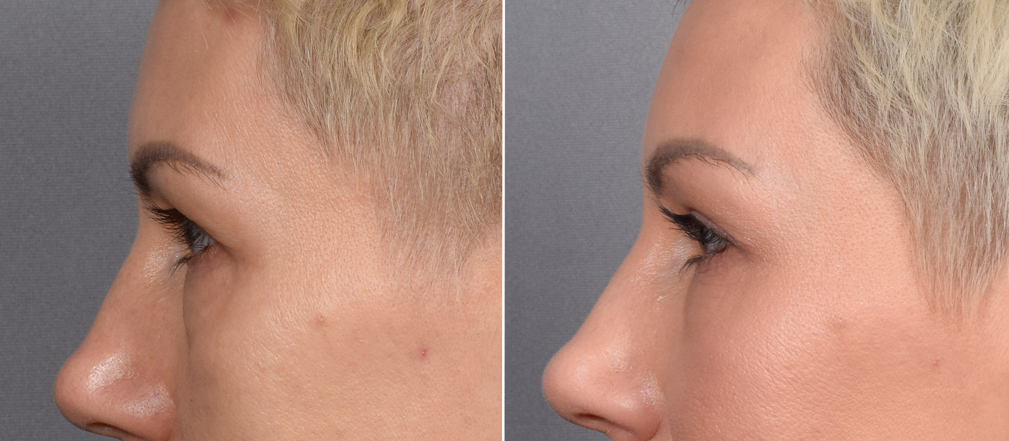 CO2 Laser Before & After Gallery - Patient 637576 - Image 10