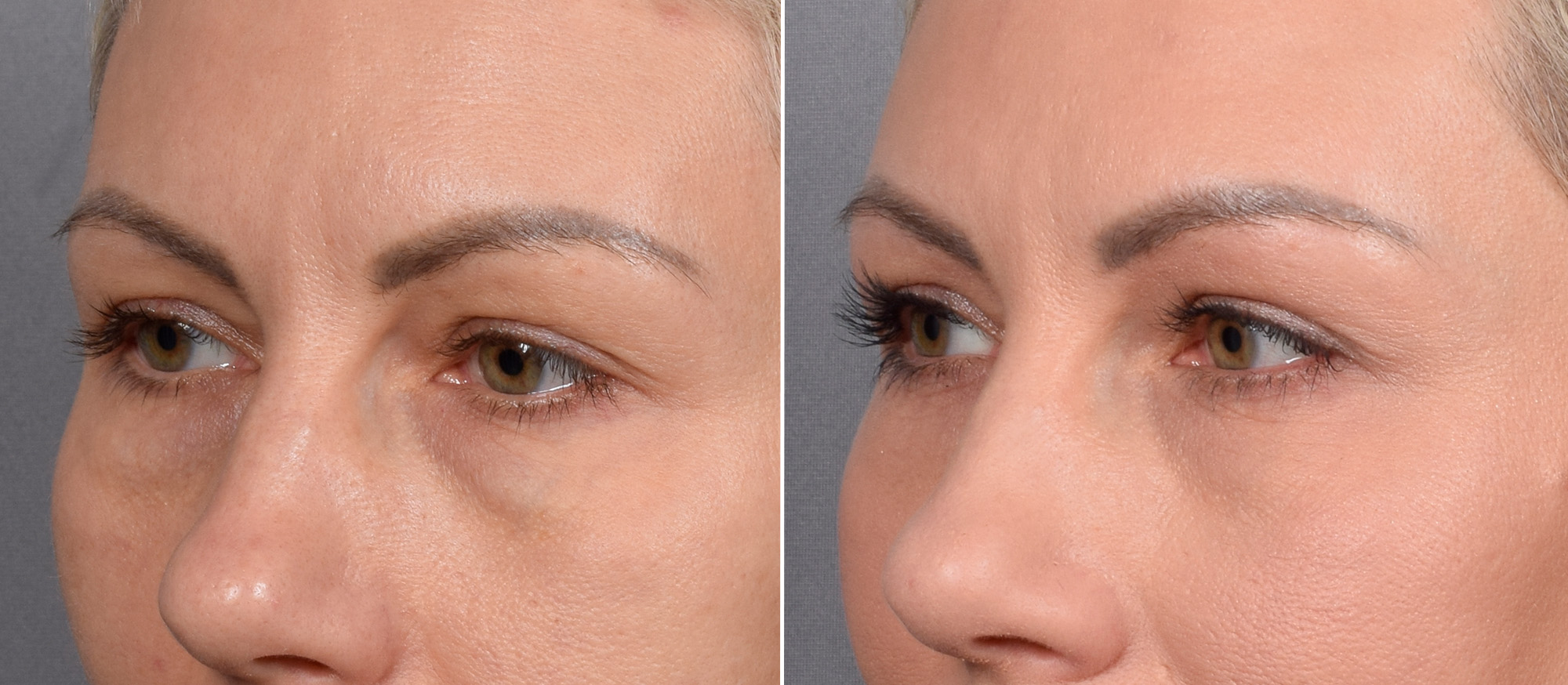 CO2 Laser Before & After Gallery - Patient 637576 - Image 9