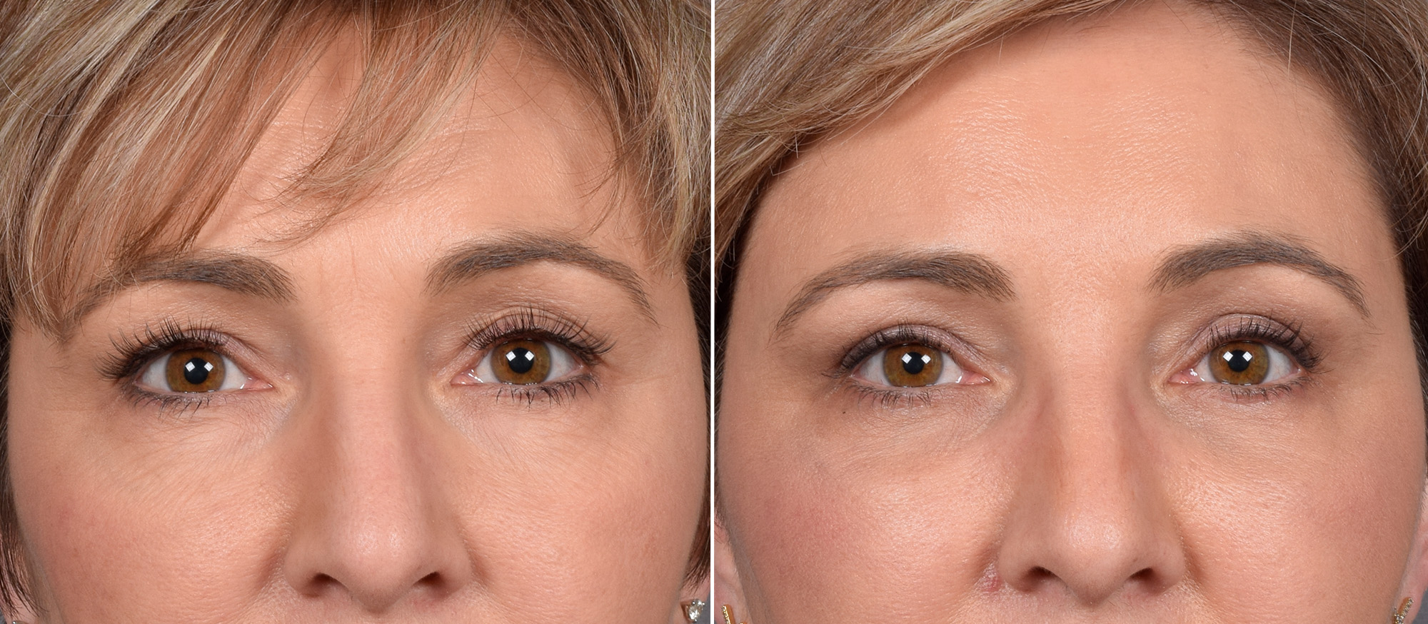 CO2 Laser Before & After Gallery - Patient 166740 - Image 8