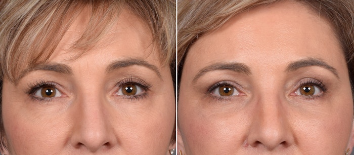 Upper Blepharoplasty Before & After Gallery - Patient 309034 - Image 1