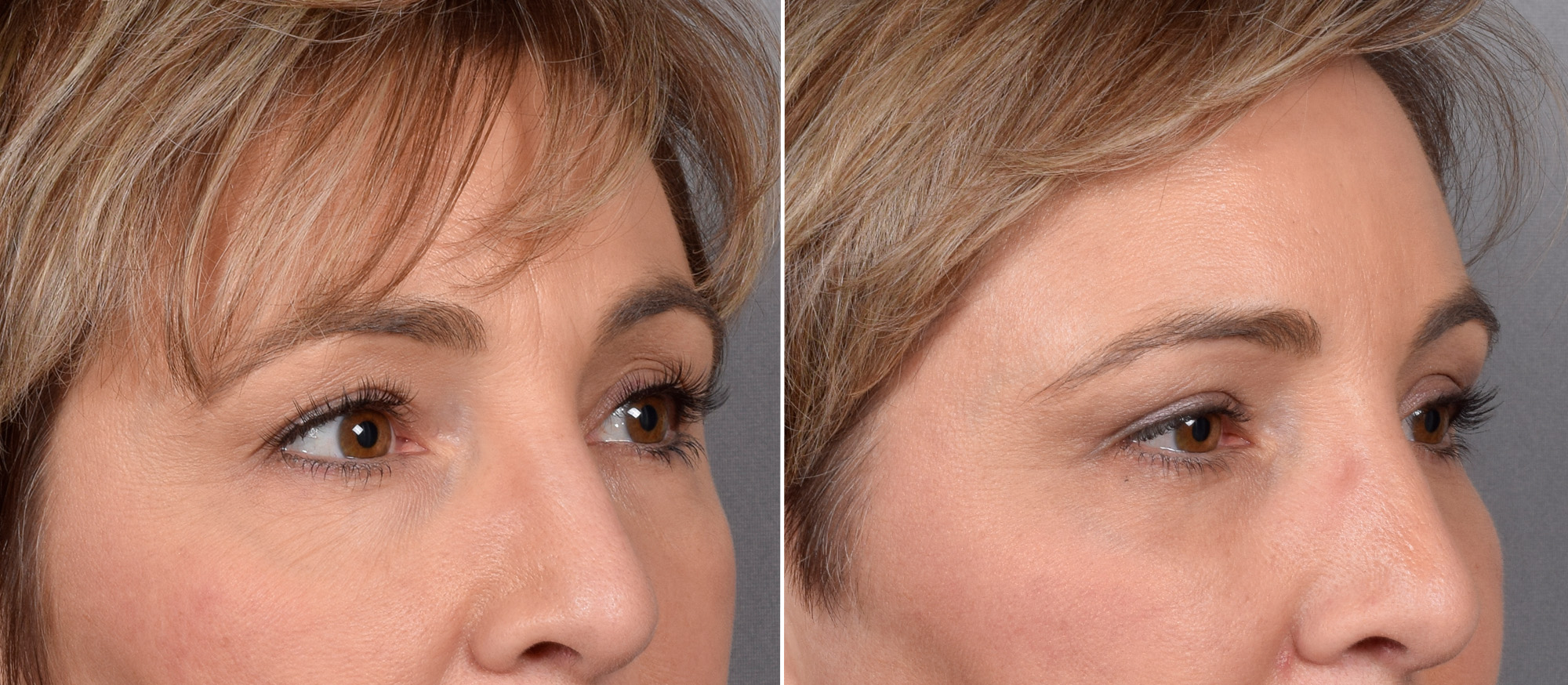CO2 Laser Before & After Gallery - Patient 166740 - Image 6