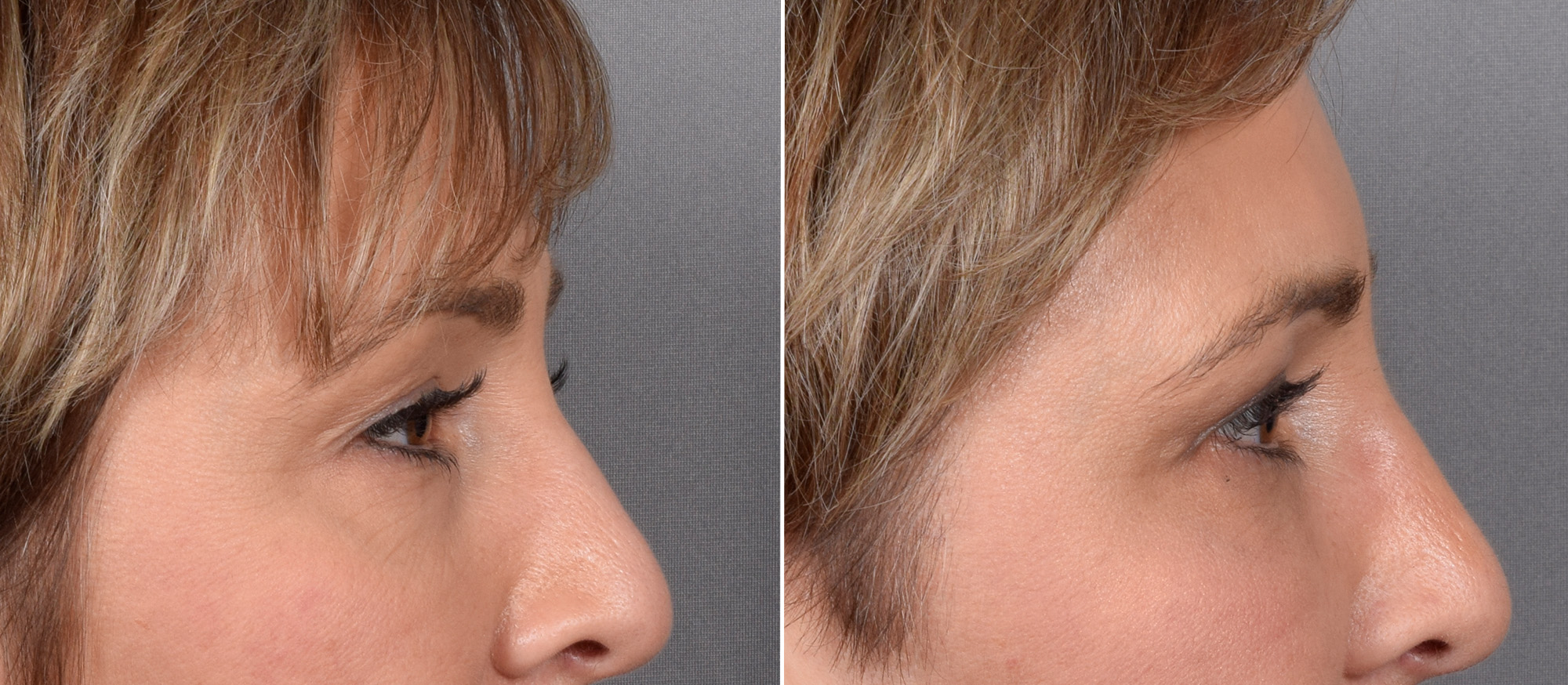 CO2 Laser Before & After Gallery - Patient 166740 - Image 7