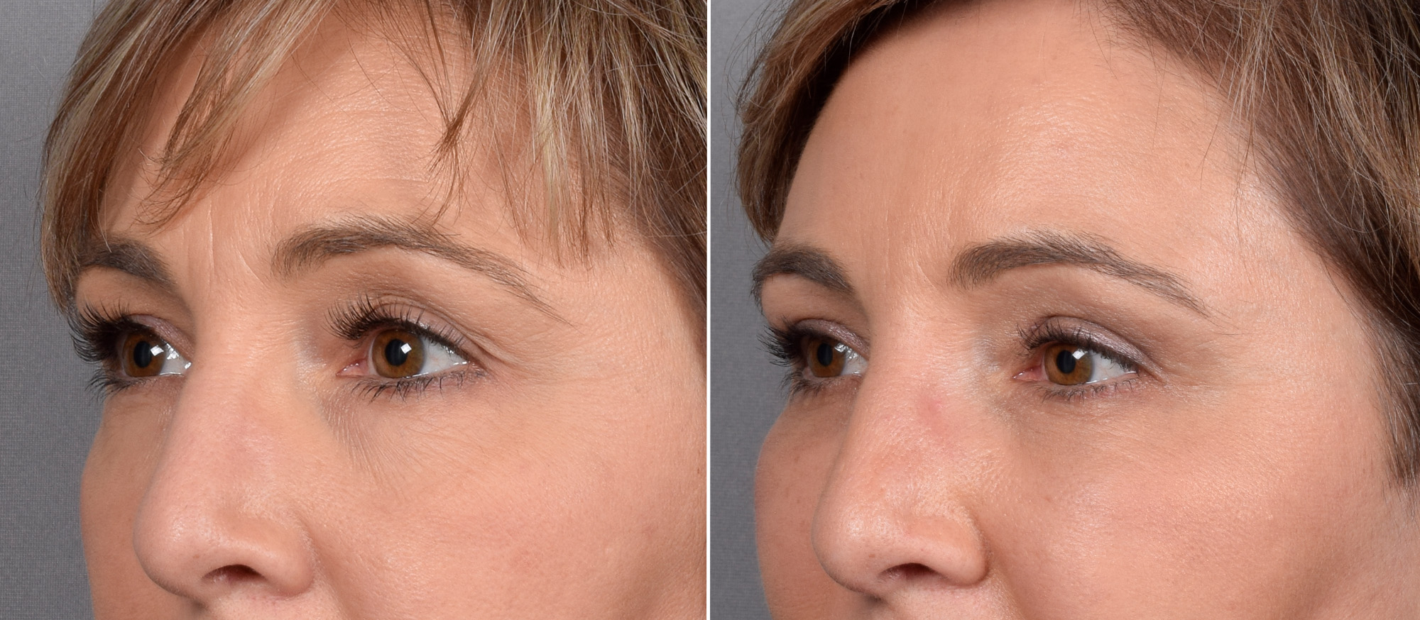 CO2 Laser Before & After Gallery - Patient 166740 - Image 9