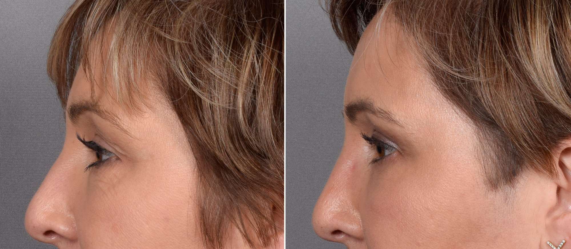 CO2 Laser Before & After Gallery - Patient 166740 - Image 10