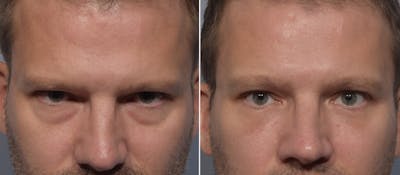 Lower Blepharoplasty Before & After Gallery - Patient 119489 - Image 1
