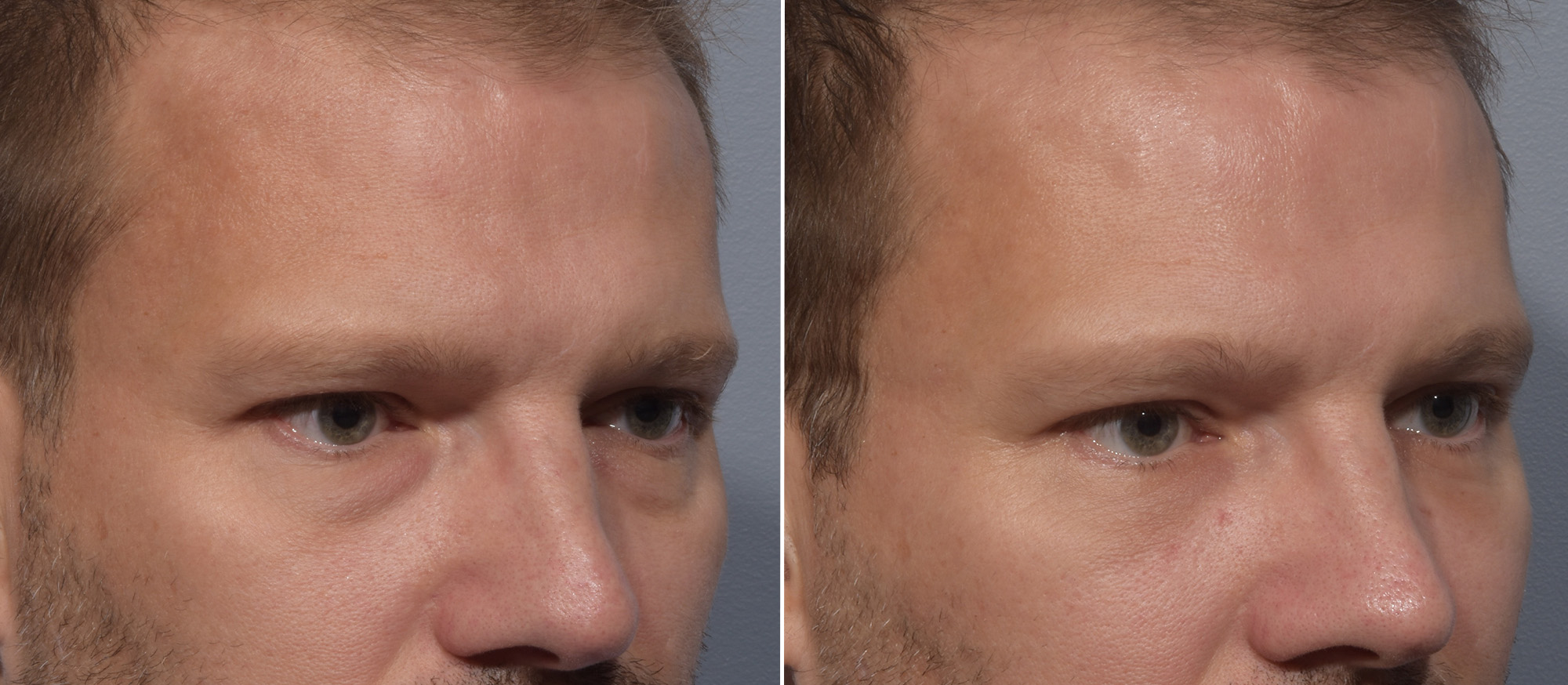 Lower Blepharoplasty Before & After Gallery - Patient 119489 - Image 2