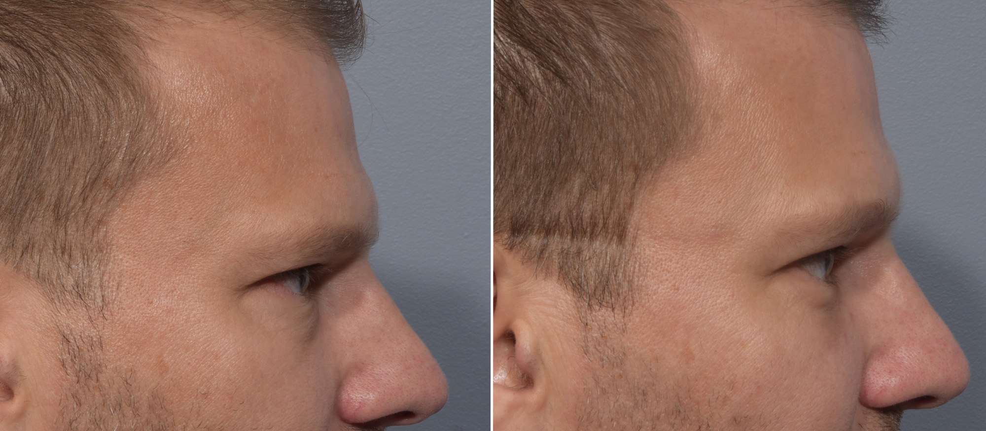 Lower Blepharoplasty Before & After Gallery - Patient 119489 - Image 3