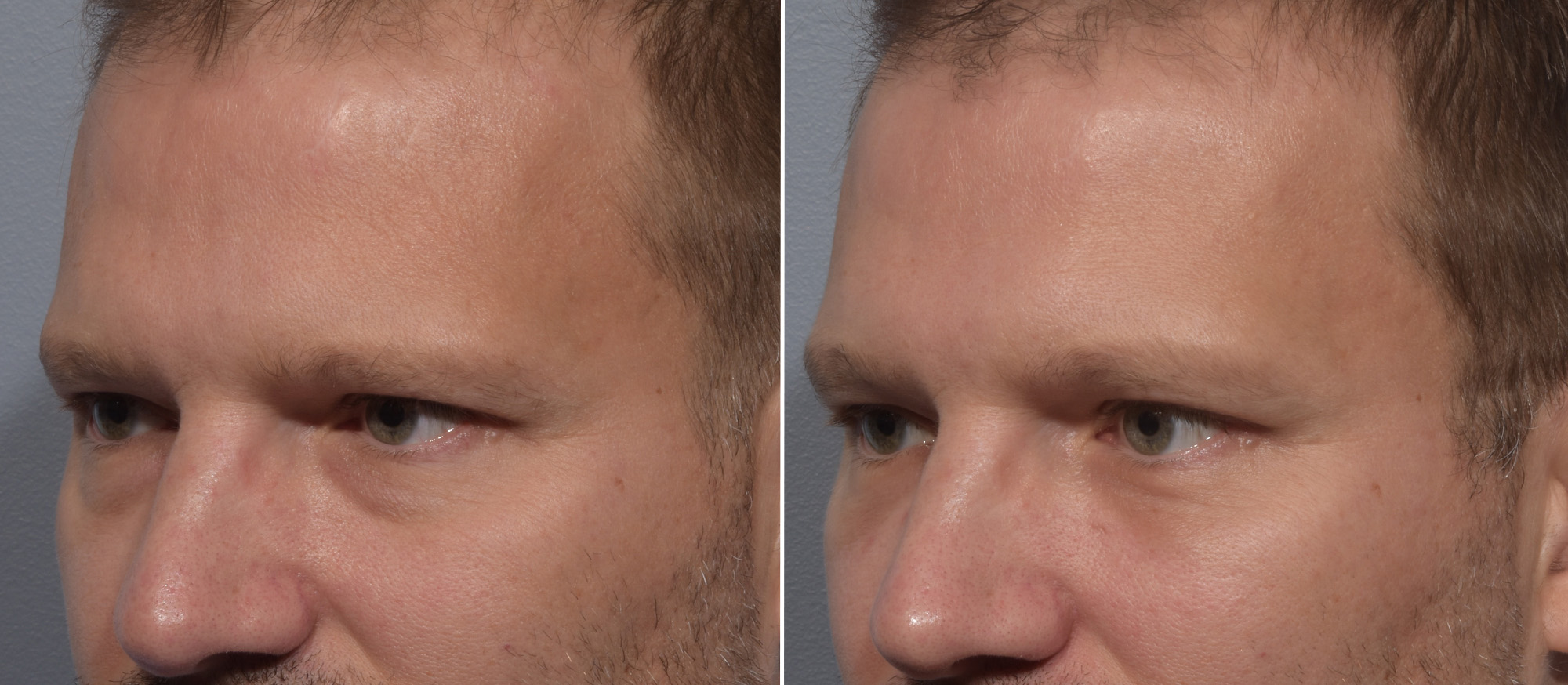 Lower Blepharoplasty Before & After Gallery - Patient 119489 - Image 4
