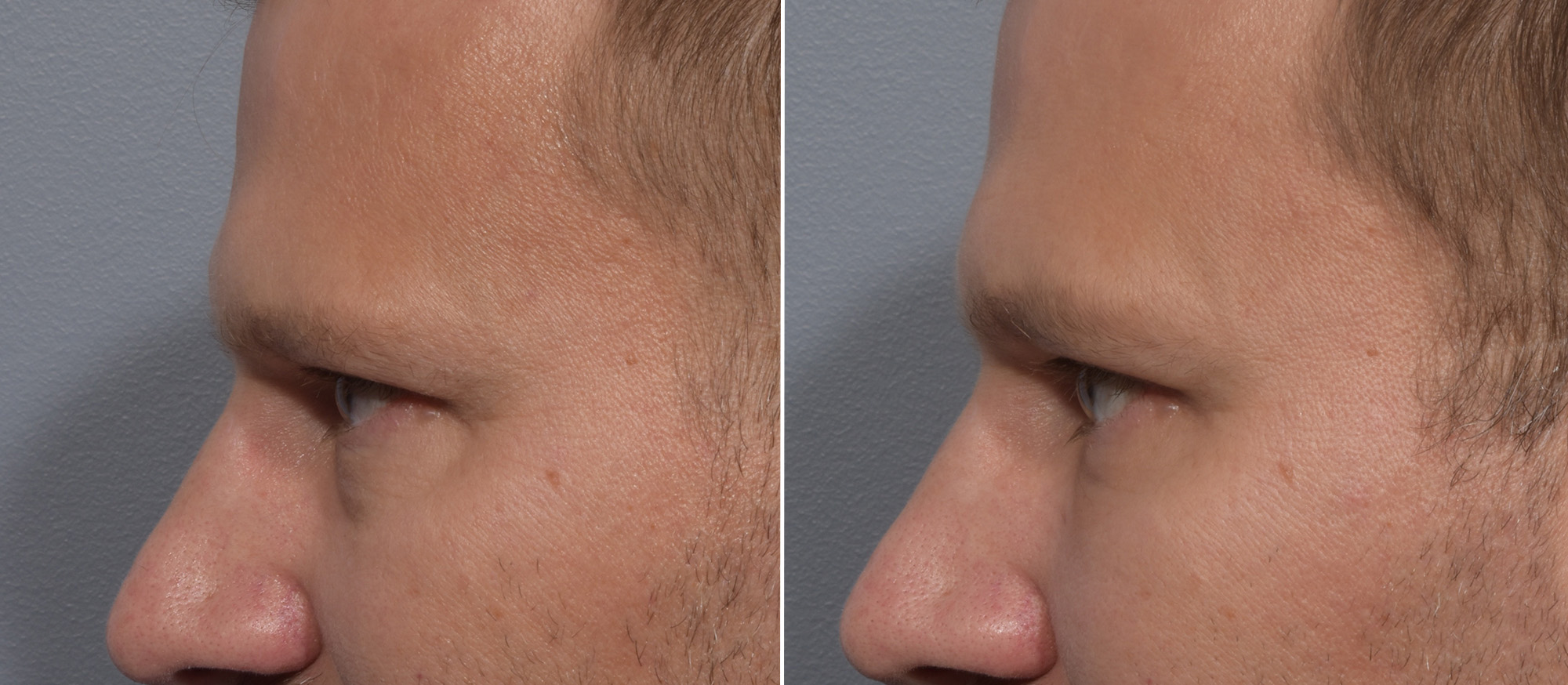 Lower Blepharoplasty Before & After Gallery - Patient 119489 - Image 5