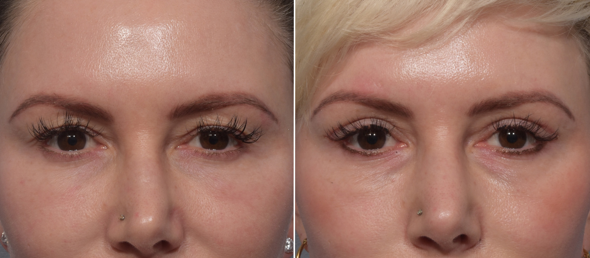 Upper Blepharoplasty Before & After Gallery - Patient 275462 - Image 1