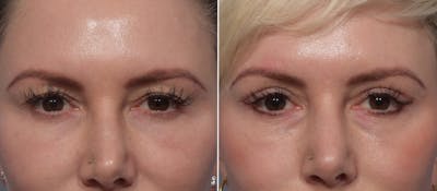 Upper Blepharoplasty Before & After Gallery - Patient 275462 - Image 1