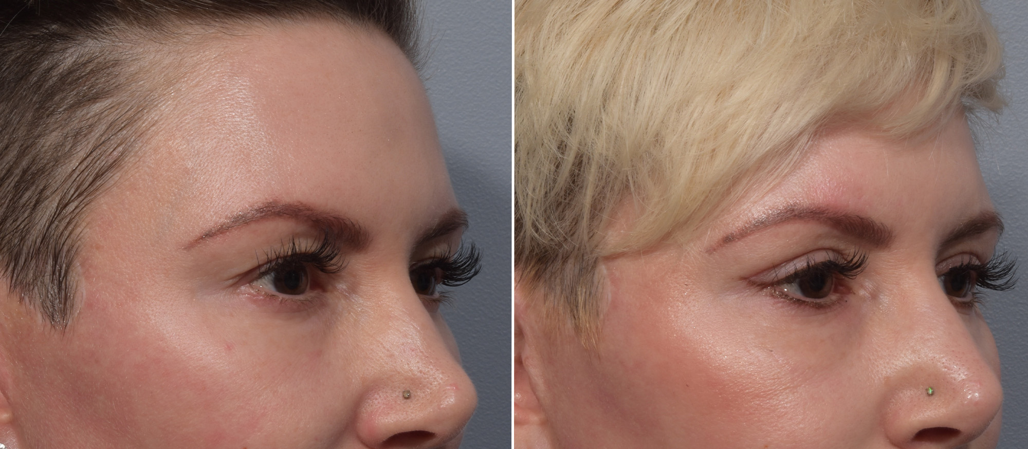 Upper Blepharoplasty Before & After Gallery - Patient 275462 - Image 2