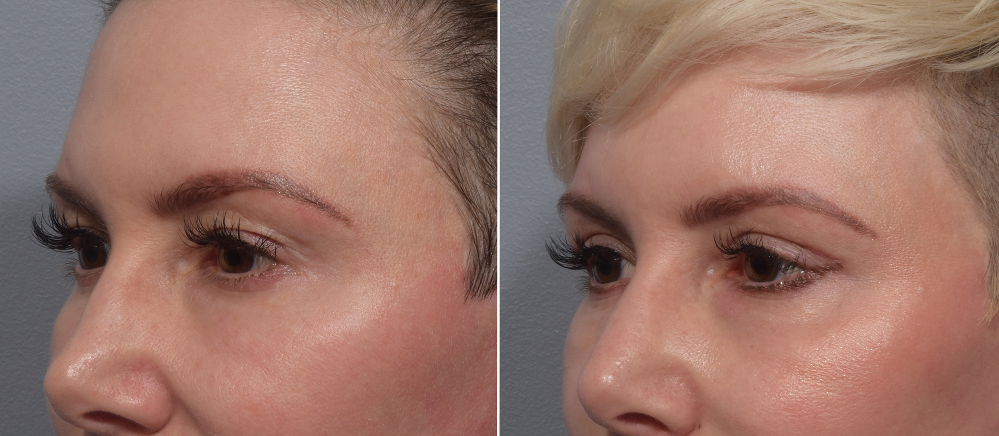 Upper Blepharoplasty Before & After Gallery - Patient 275462 - Image 4