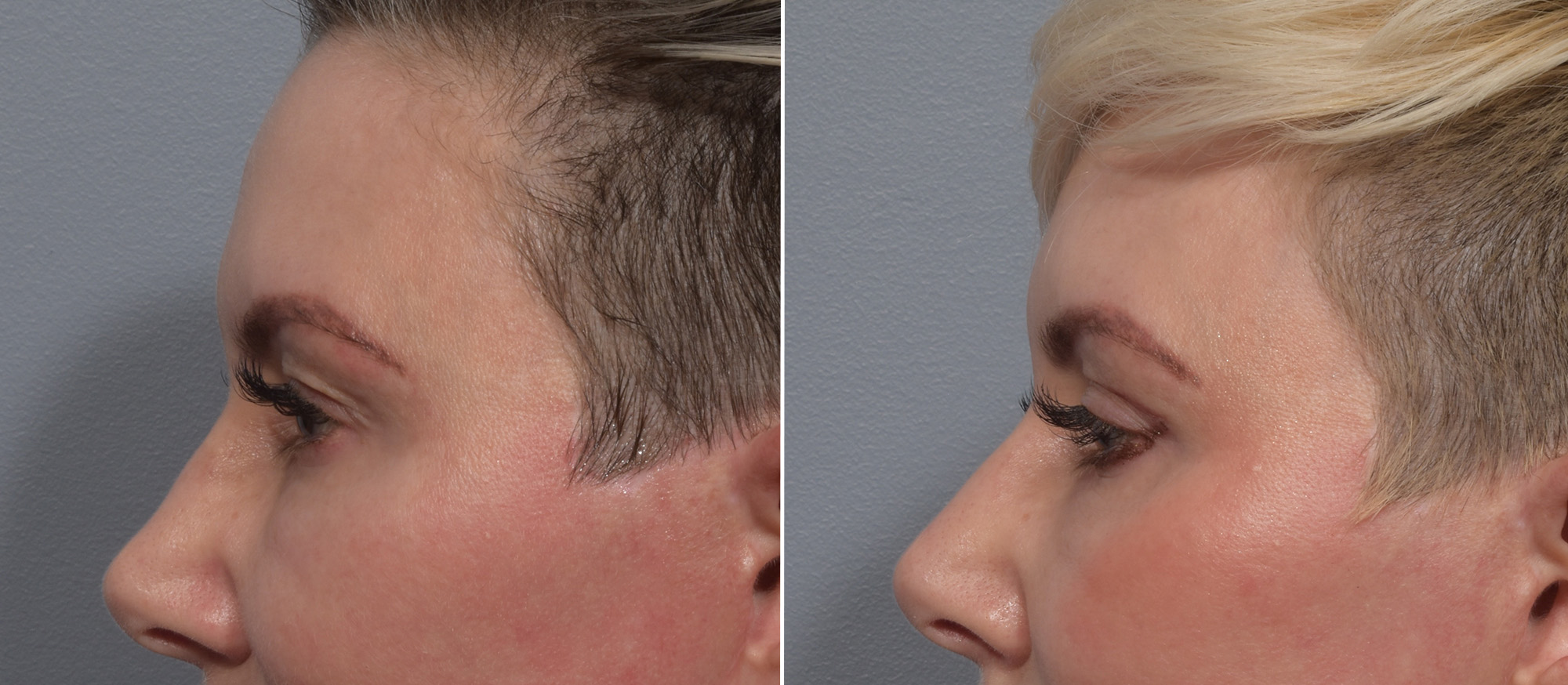 Upper Blepharoplasty Before & After Gallery - Patient 275462 - Image 5