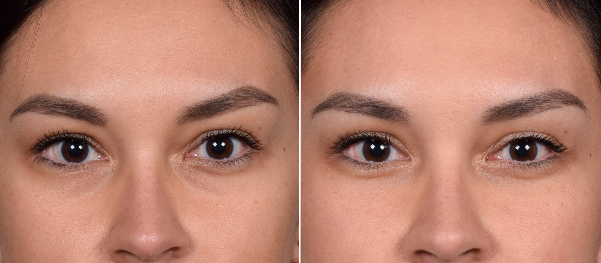 Lower Blepharoplasty Before & After Gallery - Patient 150700 - Image 1