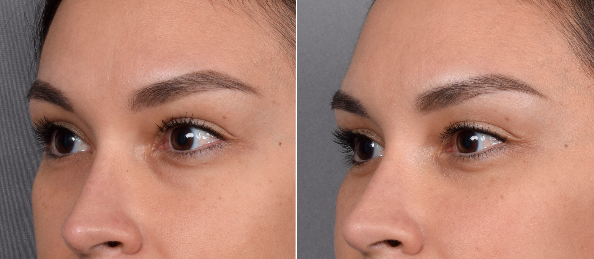 Lower Blepharoplasty Before & After Gallery - Patient 150700 - Image 4
