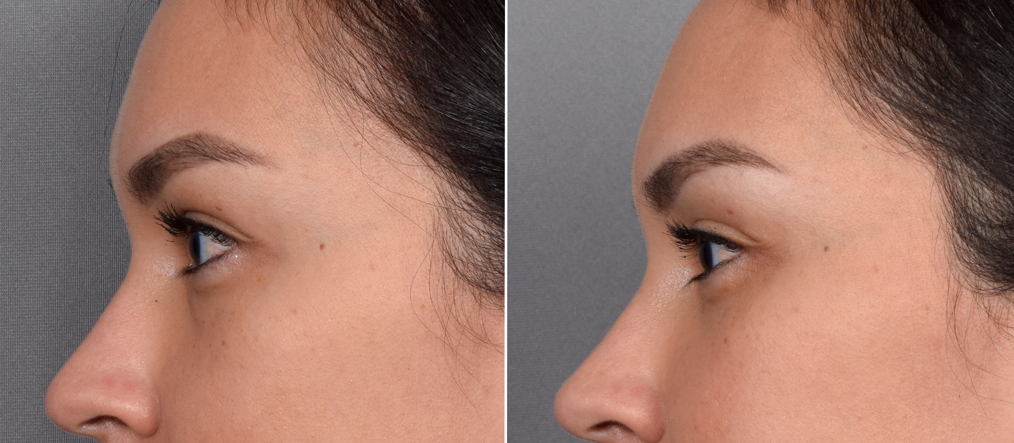 Lower Blepharoplasty Before & After Gallery - Patient 150700 - Image 5