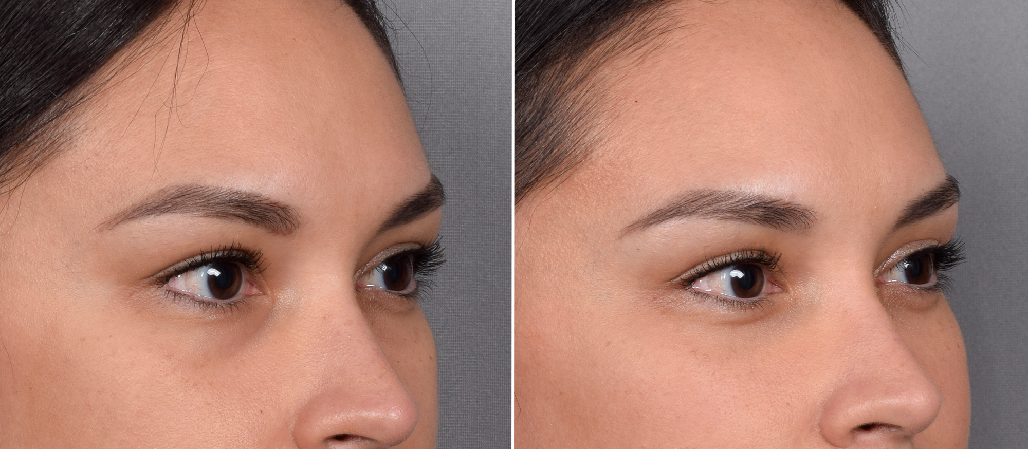 Lower Blepharoplasty Before & After Gallery - Patient 150700 - Image 2