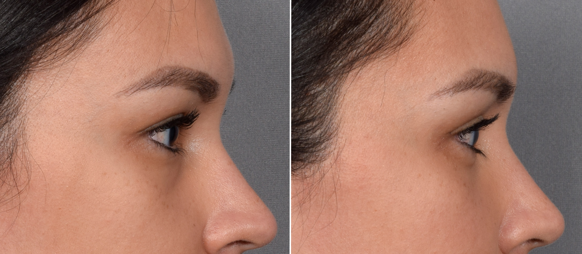 Lower Blepharoplasty Before & After Gallery - Patient 150700 - Image 3