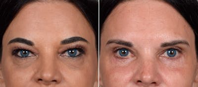 Upper Blepharoplasty Before & After Gallery - Patient 381153 - Image 1