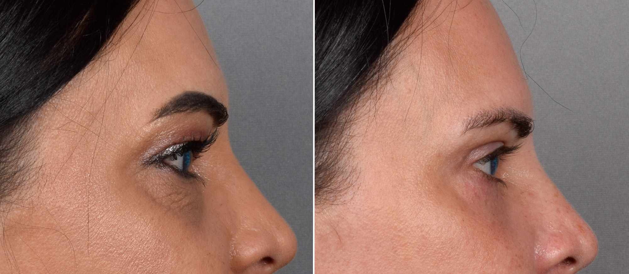 Upper Blepharoplasty Before & After Gallery - Patient 381153 - Image 3