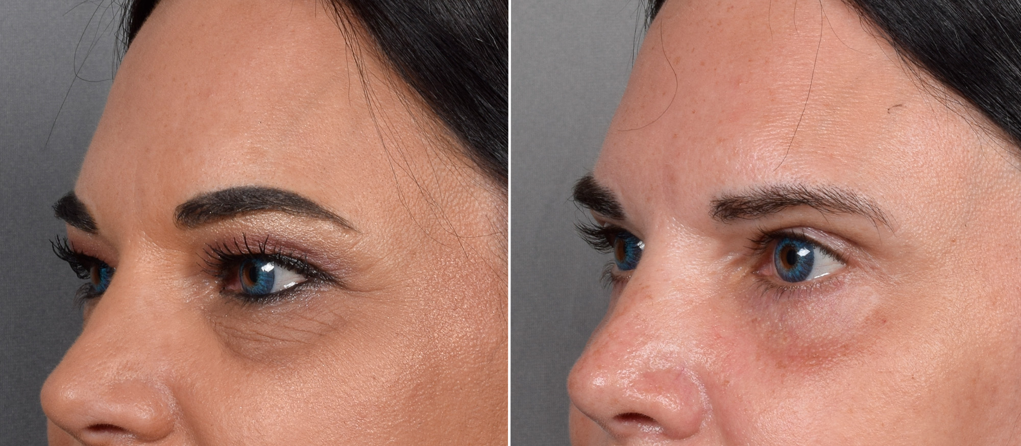 Upper Blepharoplasty Before & After Gallery - Patient 381153 - Image 4
