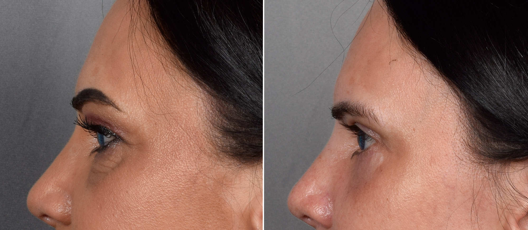 Upper Blepharoplasty Before & After Gallery - Patient 381153 - Image 5