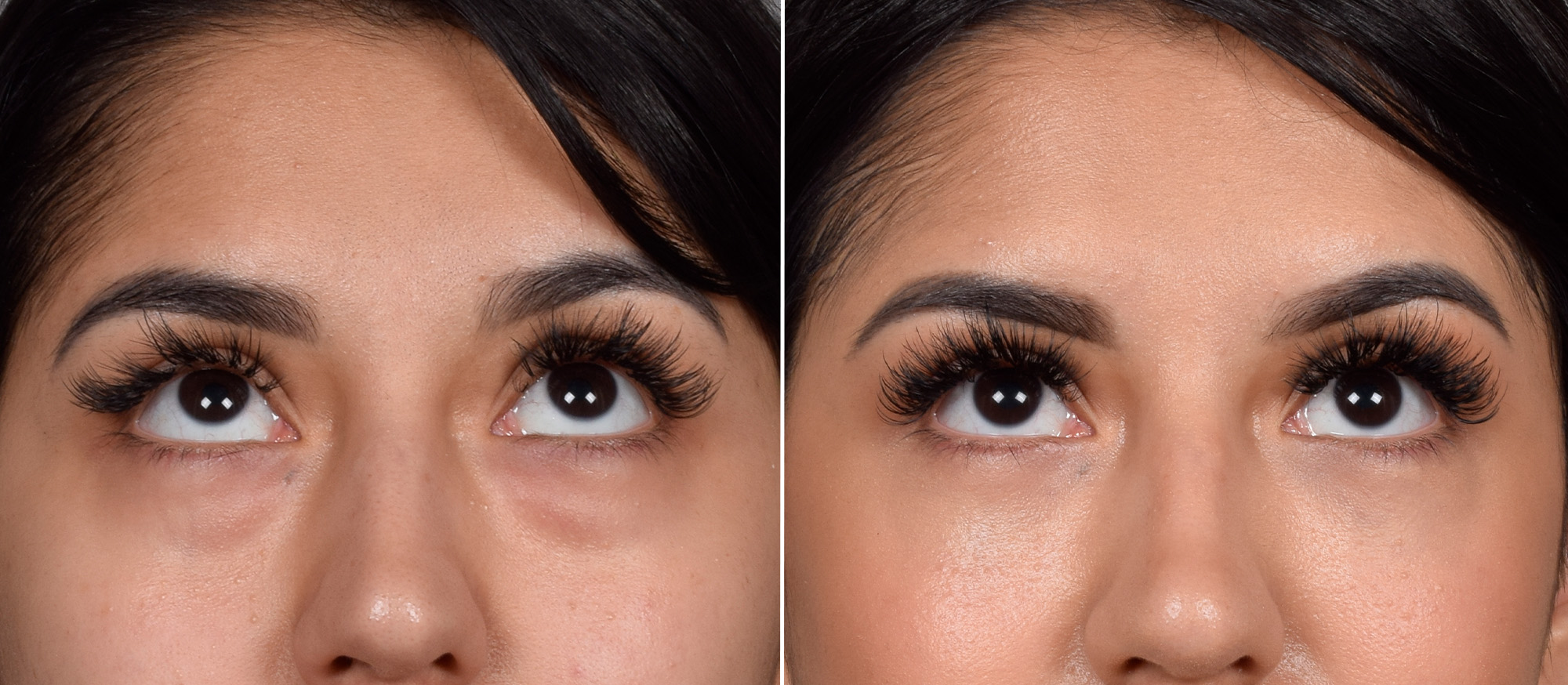 CO2 Laser Before & After Gallery - Patient 318014 - Image 7