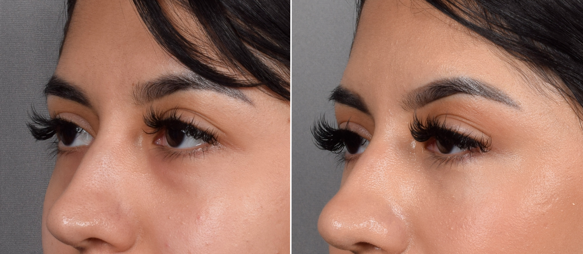 CO2 Laser Before & After Gallery - Patient 318014 - Image 10